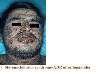 • Stevens-Johnson syndrome-ADR of sulfonamides
 