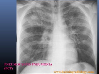 PNEUMOCYSTIS PNEUMONIA
(PCP)
                         www.learningradiology.com/
 