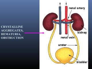 CRYSTALLINE
AGGREGATES,
HEMATURIA,
OBSTRUCTION
 