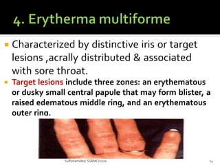  Characterized by distinctive iris or target
lesions ,acrally distributed & associated
with sore throat.
 Target lesions include three zones: an erythematous
or dusky small central papule that may form blister, a
raised edematous middle ring, and an erythematous
outer ring.
Sulfonamides/ SSRMC/2020 14
 