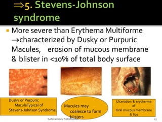  More severe than Erythema Multiforme
characterized by Dusky or Purpuric
Macules, erosion of mucous membrane
& blister in <10% of total body surface
area
Dusky or Purpuric
MaculeTypical of
Stevens-Johnson Syndrome.
Macules may
coalesce to form
blisters.
Sulfonamides/ SSRMC/2020 15
Ulceration & erytherma
of
Oral mucous membrane
& lips
 