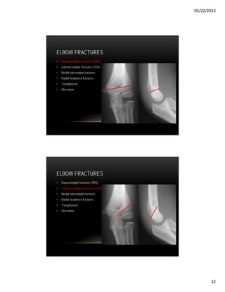 Raidal Condyle Common Fractures Of Upper Limb | PDF