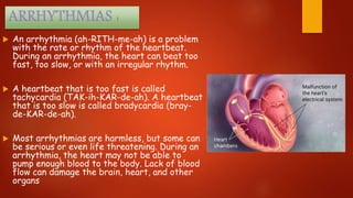  An arrhythmia (ah-RITH-me-ah) is a problem
with the rate or rhythm of the heartbeat.
During an arrhythmia, the heart can beat too
fast, too slow, or with an irregular rhythm.
 A heartbeat that is too fast is called
tachycardia (TAK-ih-KAR-de-ah). A heartbeat
that is too slow is called bradycardia (bray-
de-KAR-de-ah).
 Most arrhythmias are harmless, but some can
be serious or even life threatening. During an
arrhythmia, the heart may not be able to
pump enough blood to the body. Lack of blood
flow can damage the brain, heart, and other
organs
 