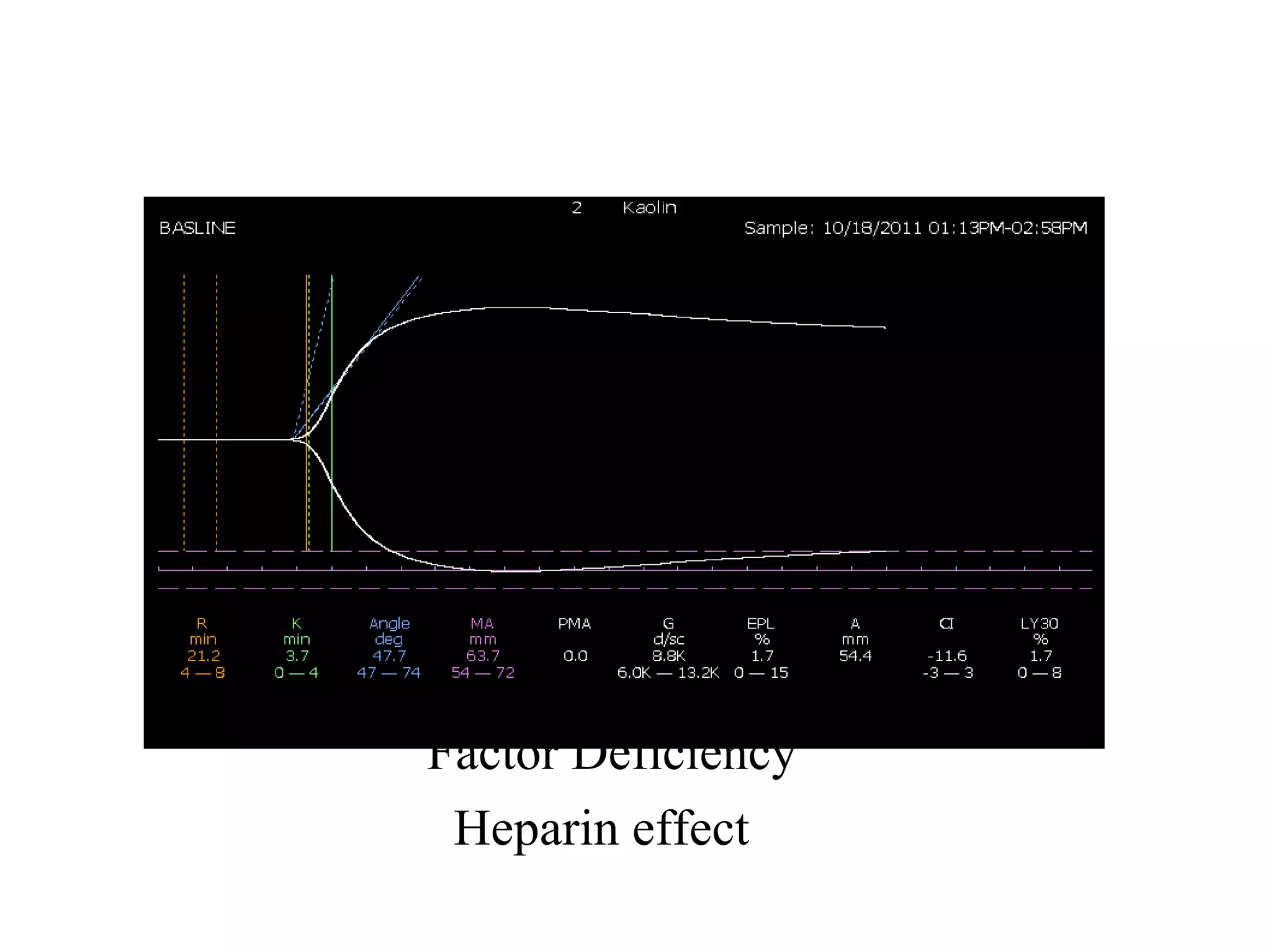 Factor Deficiency Testing thromboelastography | PPT