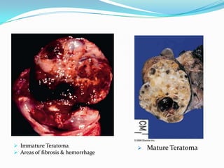  Immature Teratoma
 Areas of fibrosis & hemorrhage
 Mature Teratoma
 
