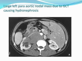 Large left para aortic nodal mass due to GCT
causing hydronephrosis
 