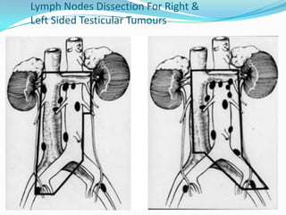 Lymph Nodes Dissection For Right &
Left Sided Testicular Tumours
 