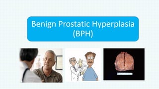 Benign Prostatic Hyperplasia
(BPH)
 