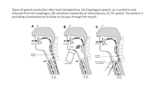 Types of speech production after total laryngectomy. (A) Esophageal speech: air is pulled in and
released from the esophagus; (B) vibrations created by an electrolarynx; (C) TE speech: the patient is
occluding a tracheostomy to allow air to pass through the mouth.
 