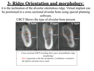 Stallion Coronal Ridge summaryofcbct-161216070820.pptx