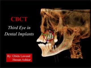 CBCT
Third Eye in
Dental Implants
By: Ghida Lawand
Hassan Ashkar
 