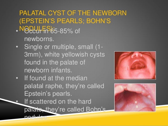 Epstein S Pearls Palatal And Gingival Cysts Of The Newborn ATYAV Epstein S Pearls Palatal And Gingival Cysts Of The Newborn ATYAV