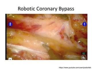 Robotic Coronary Bypass
https://www.youtube.com/user/postonlab
 