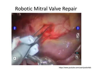 Robotic Mitral Valve Repair
https://www.youtube.com/user/postonlab
 