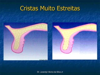 Cristas Muito Estreitas 