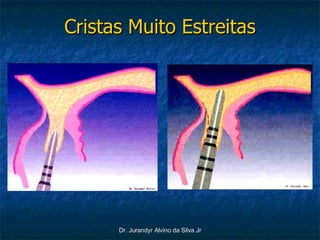 Cristas Muito Estreitas 