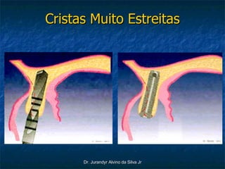 Cristas Muito Estreitas 