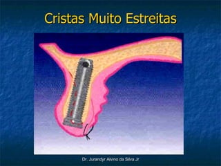 Cristas Muito Estreitas 