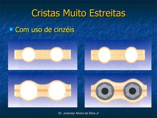 Cristas Muito Estreitas Com uso de cinzéis  