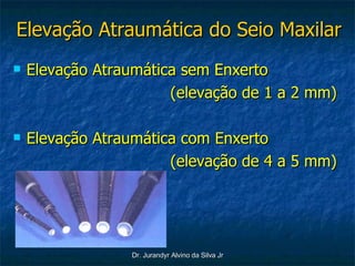 Elevação Atraumática do Seio Maxilar Elevação Atraumática sem Enxerto (elevação de 1 a 2 mm) Elevação Atraumática com Enxerto (elevação de 4 a 5 mm) 
