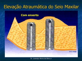 Elevação Atraumática do Seio Maxilar Com enxerto 