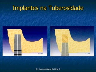 Implantes na Tuberosidade 