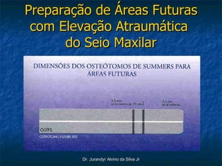 Preparação de Áreas Futuras com Elevação Atraumática  do Seio Maxilar 