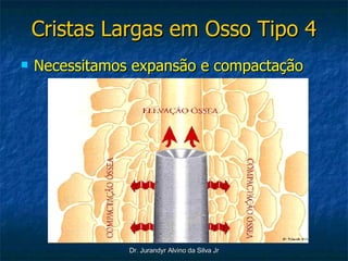 Cristas Largas em Osso Tipo 4 Necessitamos expansão e compactação 