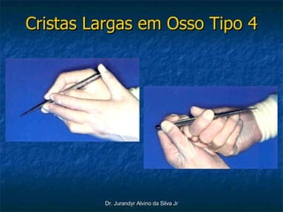 Cristas Largas em Osso Tipo 4 
