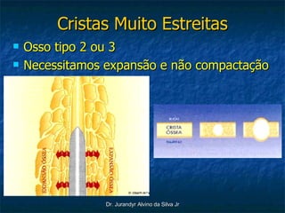Cristas Muito Estreitas Osso tipo 2 ou 3 Necessitamos expansão e não compactação 