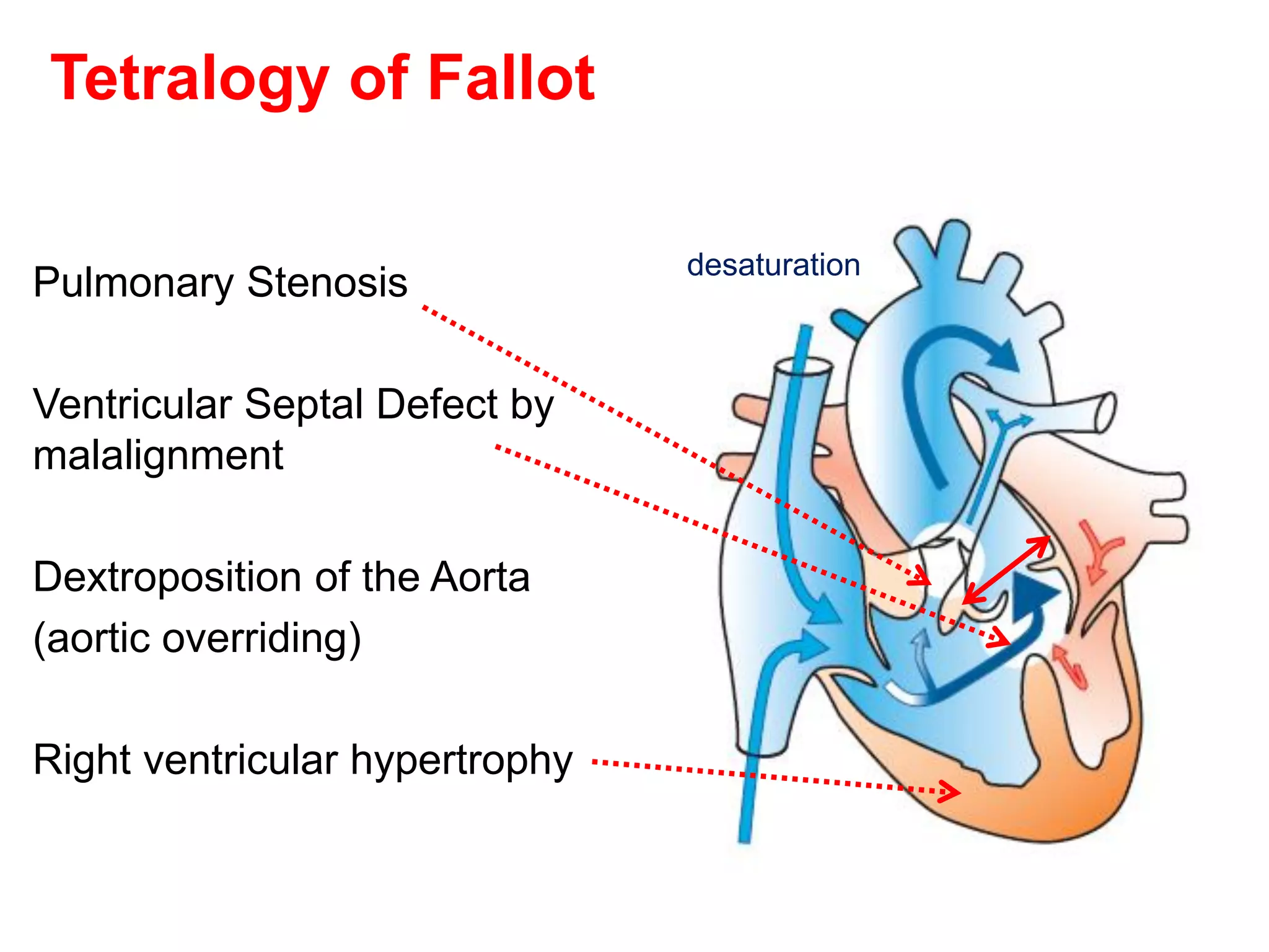 Tetralogy of Fallot

                                desaturation
Pulmonary Stenosis

Ventricular Septal Defect by
malalignment

Dextroposition of the Aorta
(aortic overriding)

Right ventricular hypertrophy
 