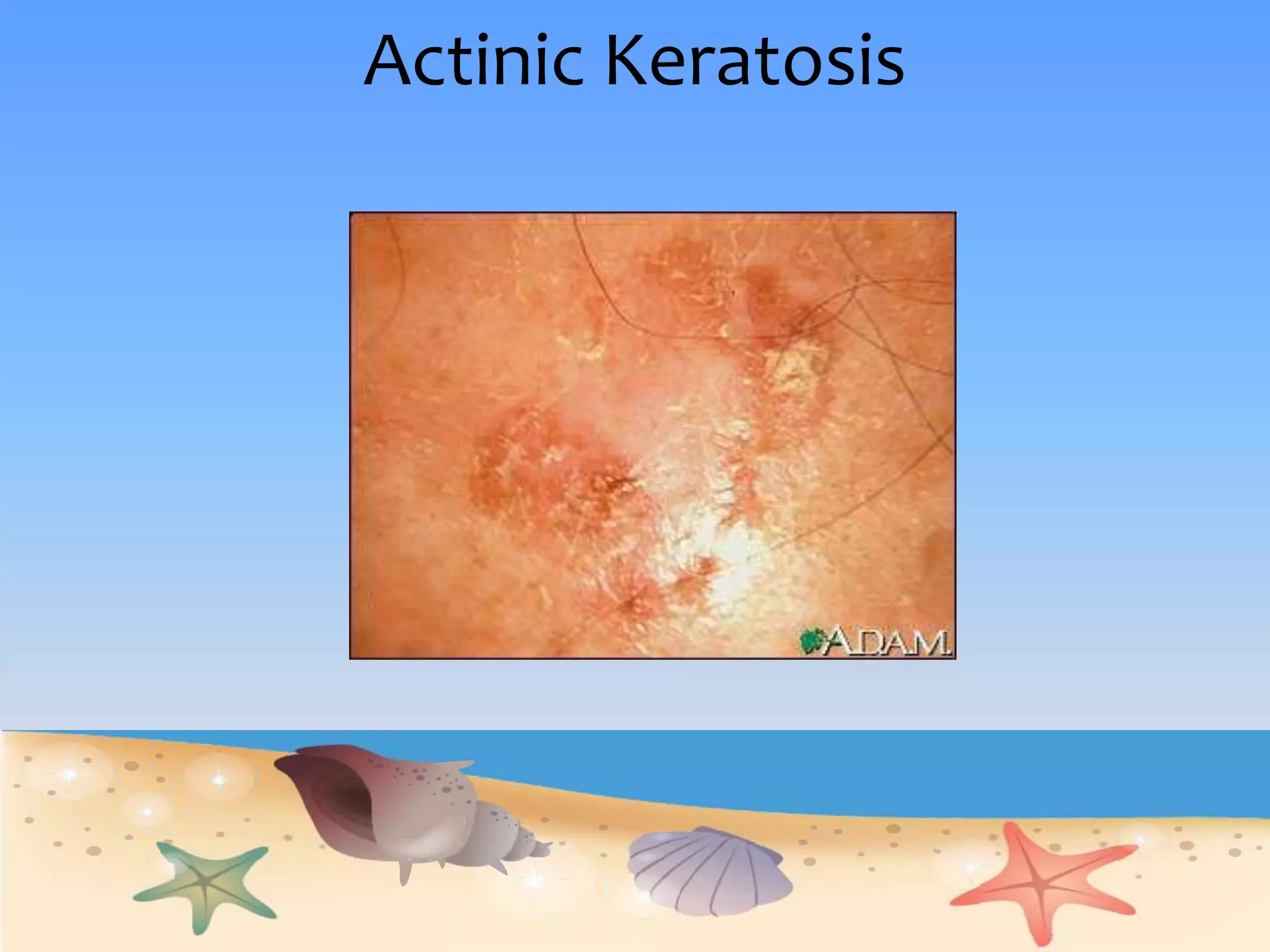 Actinic Keratosis