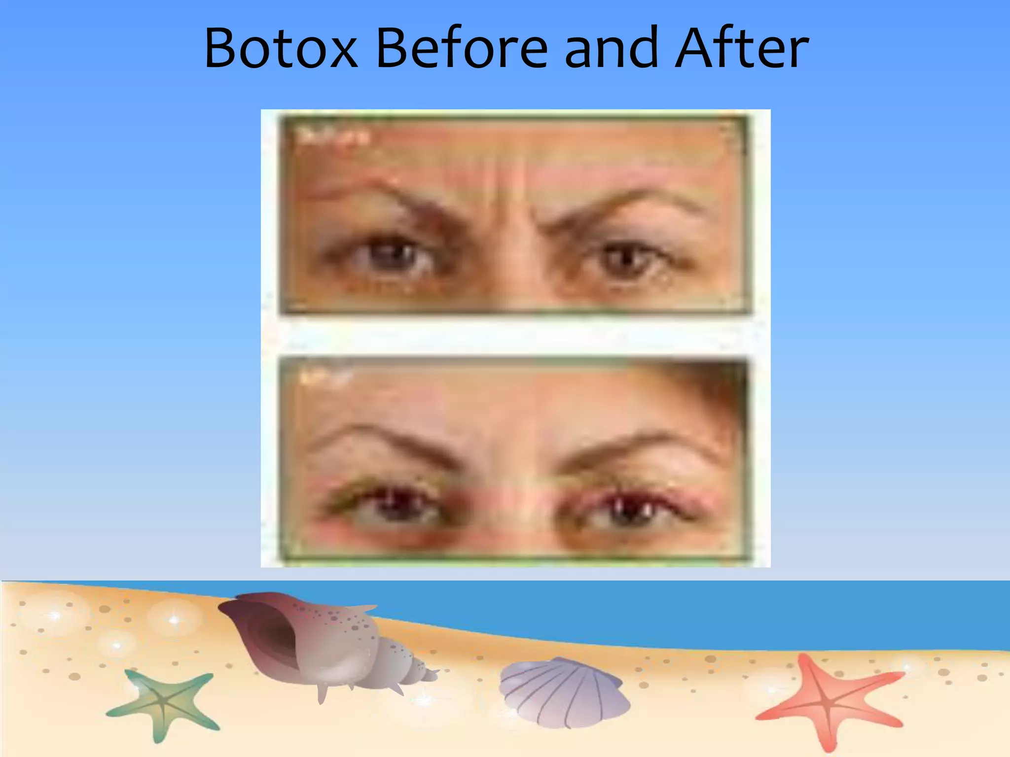How Does Botox WorkBotox works by blocking a chemical that aids in muscle contraction called acetylcholine When the nerve sends a signal to the muscle to contract, acetylcholine is released as before, but it can't bind anywhere on the muscle due to the BotoxThe muscle has no idea it is supposed to contract. It is essentially paralyzed, but not because the muscle  or the nerve have been damaged.Reminder…Botox takes 72 hours to reach maximum effect….be patient because beauty takes time.  