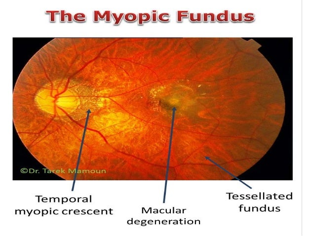 pathological myopia signs pathological myopia signs