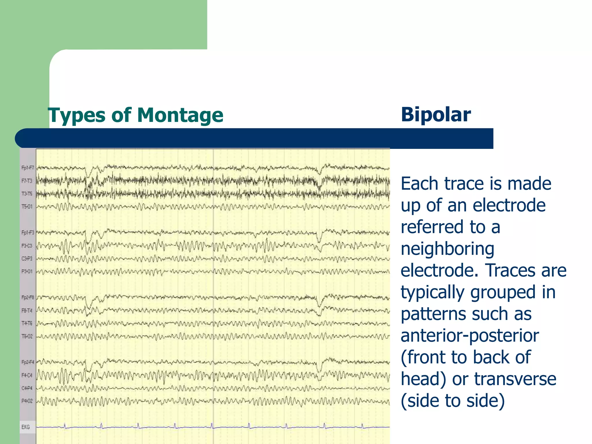 Types of Montage Bipolar
Each trace is made
up of an electrode
referred to a
neighboring
electrode. Traces are
typically grouped in
patterns such as
anterior-posterior
(front to back of
head) or transverse
(side to side)
 