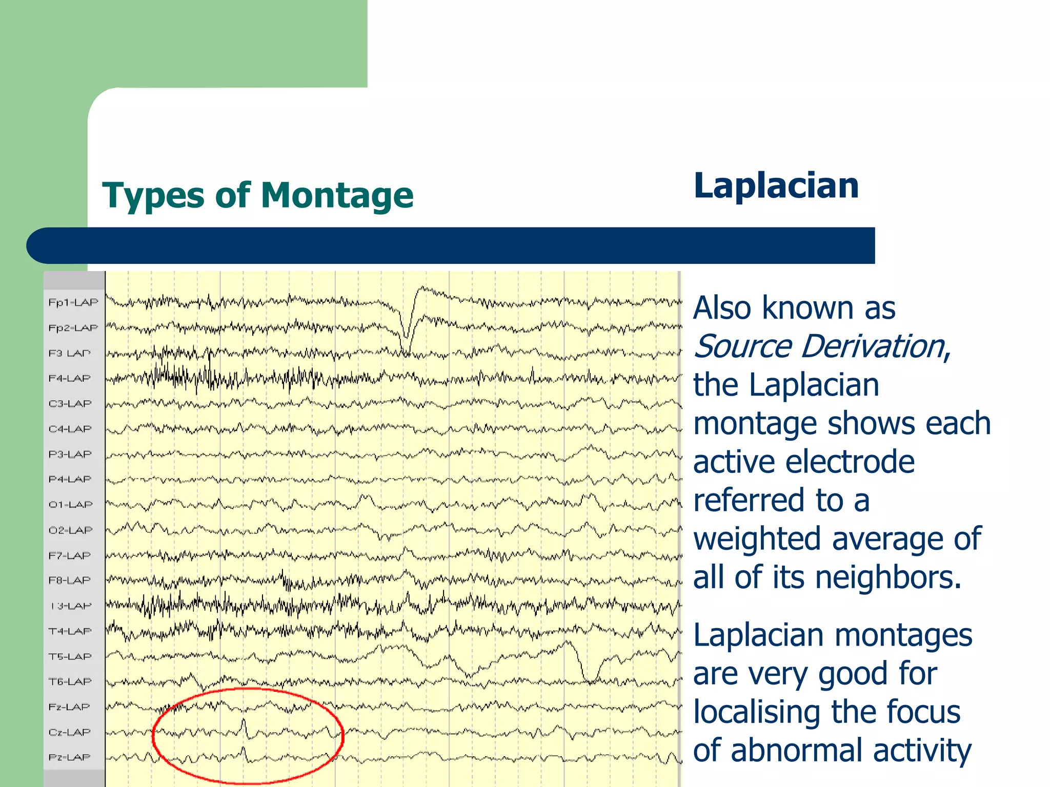 Types of Montage Laplacian
Also known as
Source Derivation,
the Laplacian
montage shows each
active electrode
referred to a
weighted average of
all of its neighbors.
Laplacian montages
are very good for
localising the focus
of abnormal activity
 