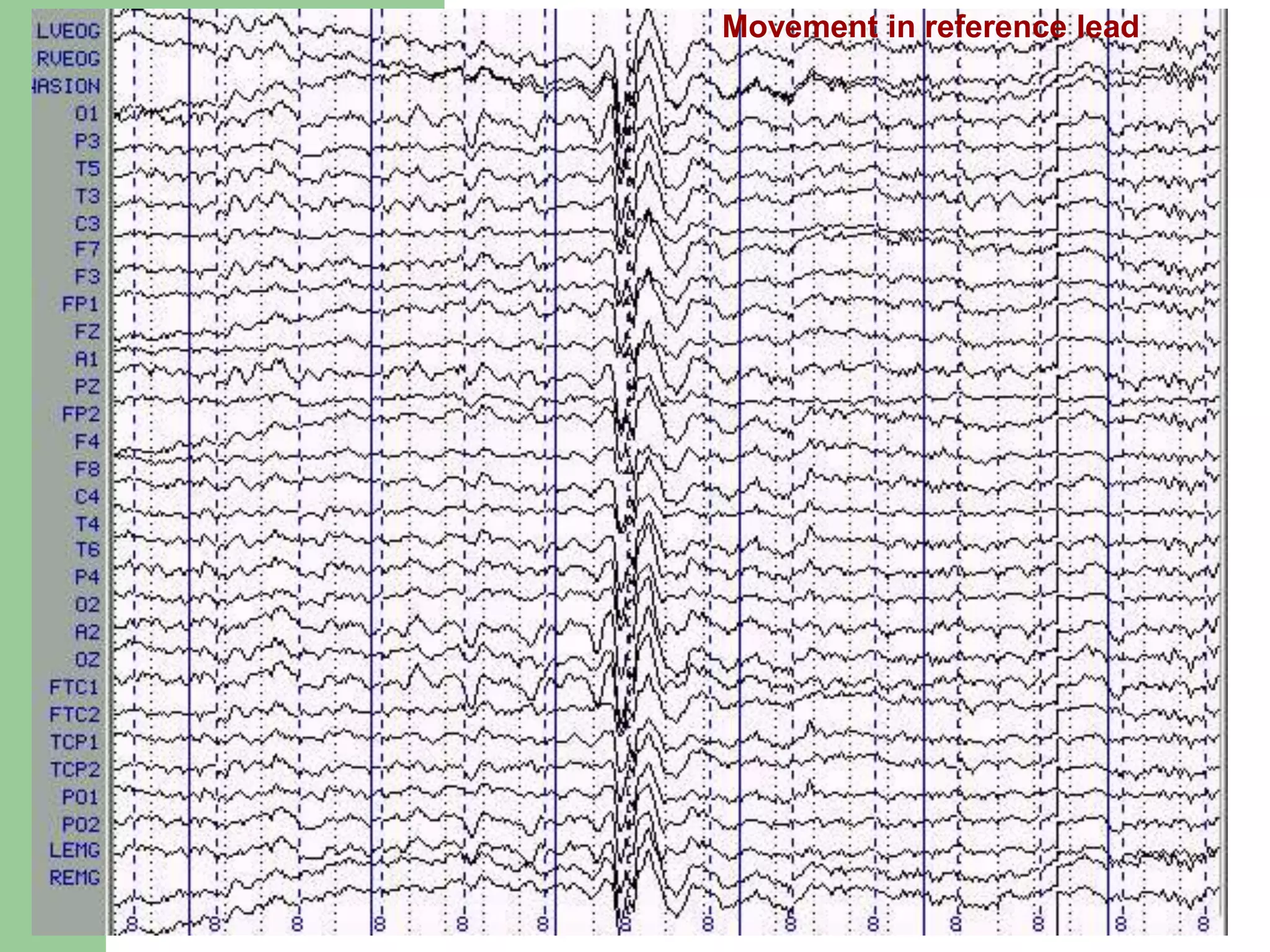 Movement in reference lead
 