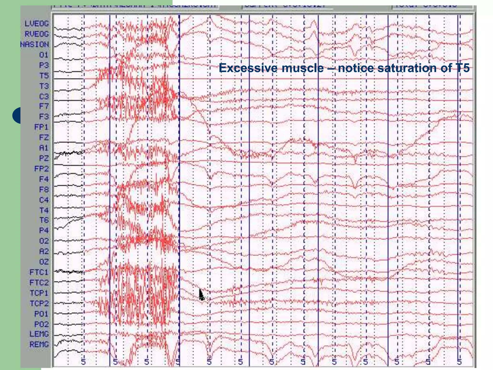 Excessive muscle – notice saturation of T5
 
