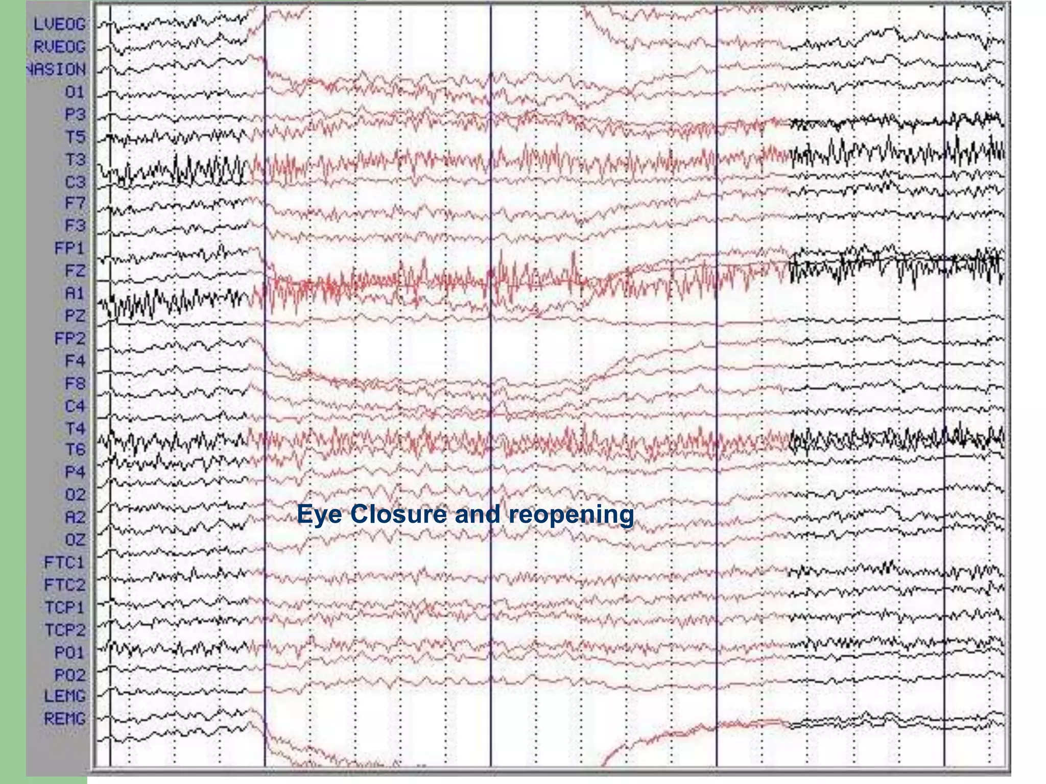 Eye Closure and reopening
 