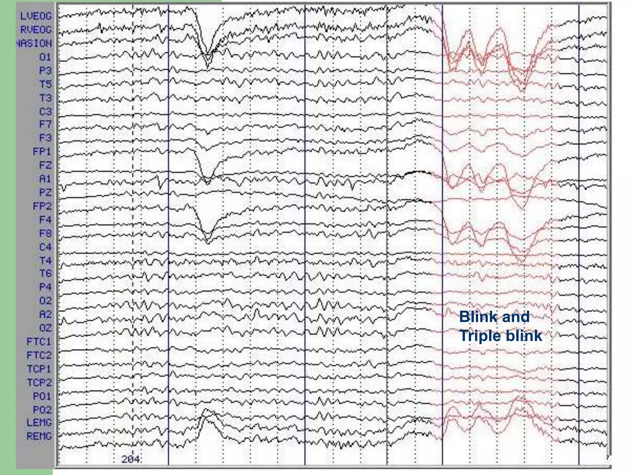 Blink and
Triple blink
 