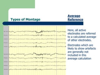 Types of Montage
Average
Reference
Here, all active
electrodes are referred
to a calculated average
of other electrodes.
Electrodes which are
likely to show artefacts
are generally not
included in this
average calculation
 