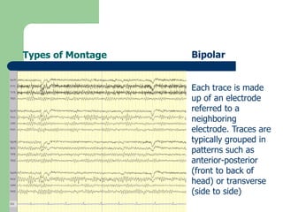 Types of Montage Bipolar
Each trace is made
up of an electrode
referred to a
neighboring
electrode. Traces are
typically grouped in
patterns such as
anterior-posterior
(front to back of
head) or transverse
(side to side)
 