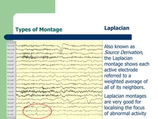 Types of Montage Laplacian
Also known as
Source Derivation,
the Laplacian
montage shows each
active electrode
referred to a
weighted average of
all of its neighbors.
Laplacian montages
are very good for
localising the focus
of abnormal activity
 