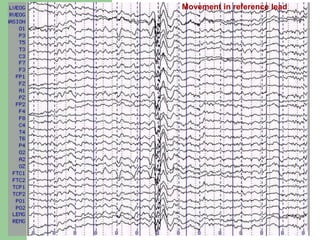 Movement in reference lead
 