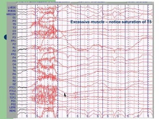 Excessive muscle – notice saturation of T5
 