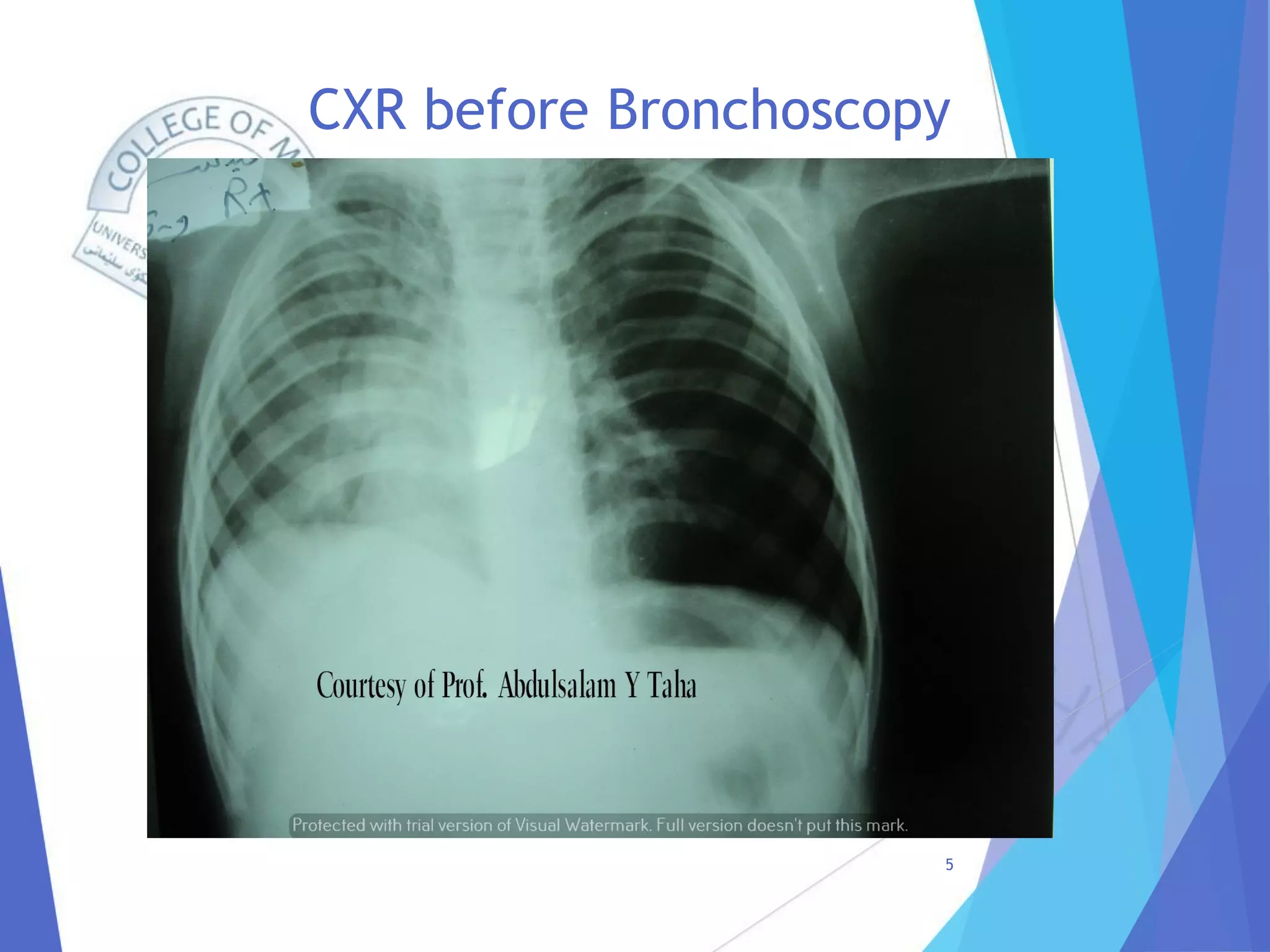 CXR before Bronchoscopy
5
 