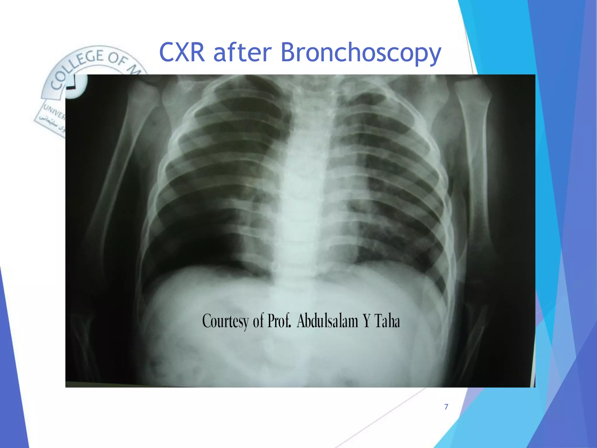 CXR after Bronchoscopy
7
 