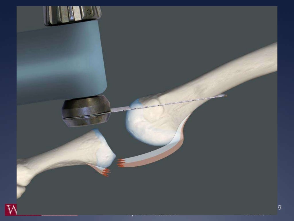 Dorsal Anatomic Plantar Plate Repair