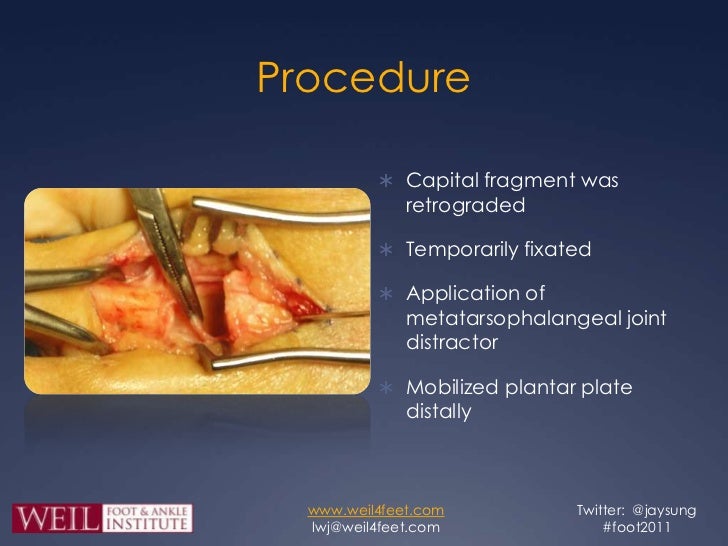 Dorsal Anatomic Plantar Plate Repair Dorsal Anatomic Plantar Plate Repair