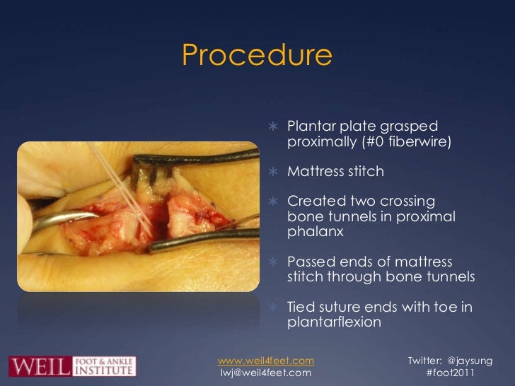 Dorsal Anatomic Plantar Plate Repair